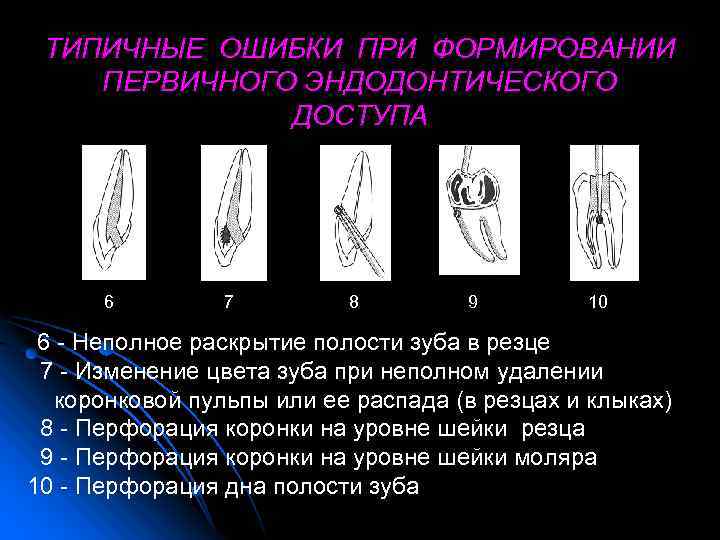 ТИПИЧНЫЕ ОШИБКИ ПРИ ФОРМИРОВАНИИ ПЕРВИЧНОГО ЭНДОДОНТИЧЕСКОГО ДОСТУПА 6 7 8 9 10 6 -