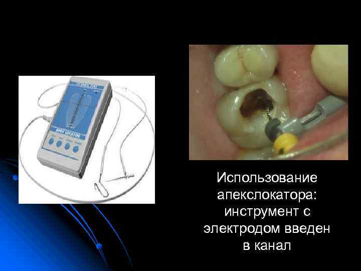 Использование апекслокатора: инструмент с электродом введен в канал 