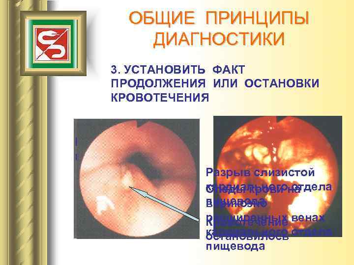 ОБЩИЕ ПРИНЦИПЫ ДИАГНОСТИКИ 3. УСТАНОВИТЬ ФАКТ ПРОДОЛЖЕНИЯ ИЛИ ОСТАНОВКИ КРОВОТЕЧЕНИЯ Продолжающееся кровотечение Разрыв слизистой