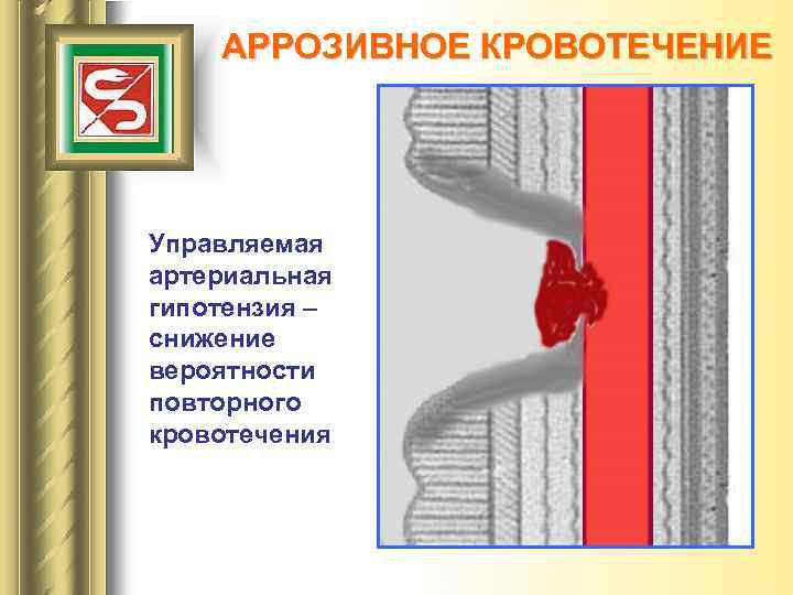 АРРОЗИВНОЕ КРОВОТЕЧЕНИЕ Управляемая артериальная гипотензия – снижение вероятности повторного кровотечения 