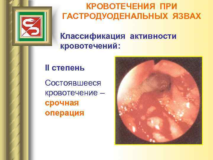 КРОВОТЕЧЕНИЯ ПРИ ГАСТРОДУОДЕНАЛЬНЫХ ЯЗВАХ Классификация активности кровотечений: II степень Состоявшееся кровотечение – срочная операция