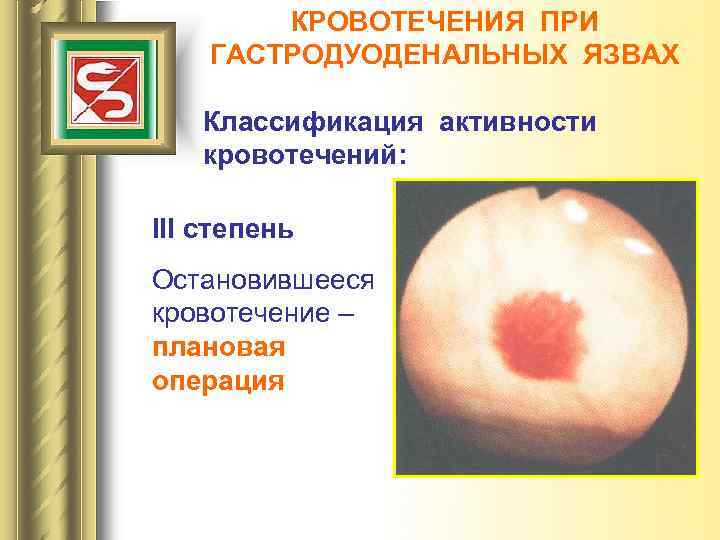 КРОВОТЕЧЕНИЯ ПРИ ГАСТРОДУОДЕНАЛЬНЫХ ЯЗВАХ Классификация активности кровотечений: III степень Остановившееся кровотечение – плановая операция