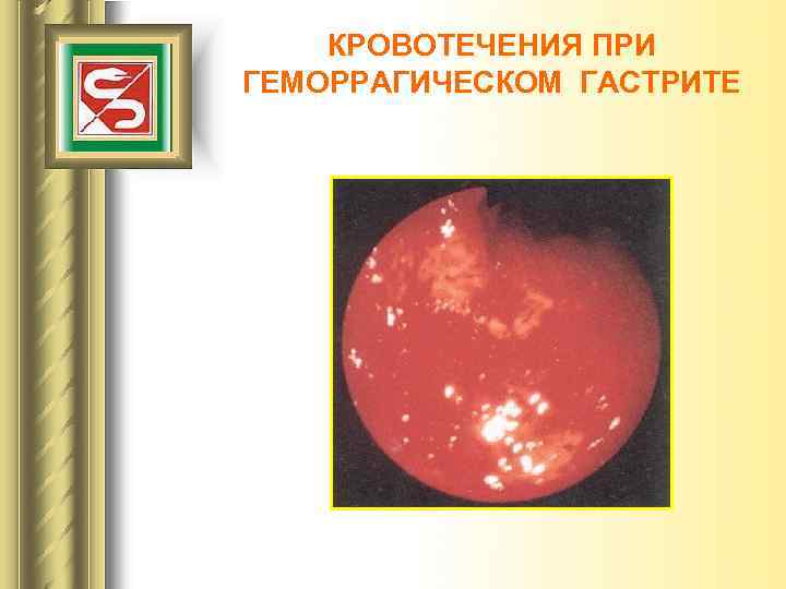КРОВОТЕЧЕНИЯ ПРИ ГЕМОРРАГИЧЕСКОМ ГАСТРИТЕ 