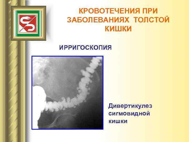 КРОВОТЕЧЕНИЯ ПРИ ЗАБОЛЕВАНИЯХ ТОЛСТОЙ КИШКИ ИРРИГОСКОПИЯ Дивертикулез сигмовидной кишки 