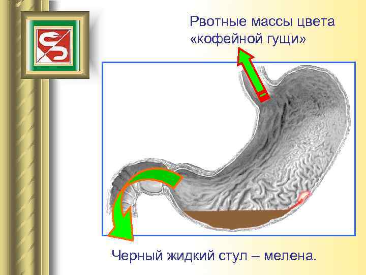 Рвотные массы цвета «кофейной гущи» HCl Черный жидкий стул – мелена. 
