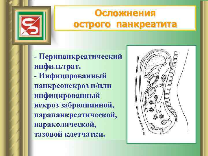 Осложнения острого панкреатита - Перипанкреатический инфильтрат. - Инфицированный панкреонекроз и/или инфицированный некроз забрюшинной, парапанкреатической,