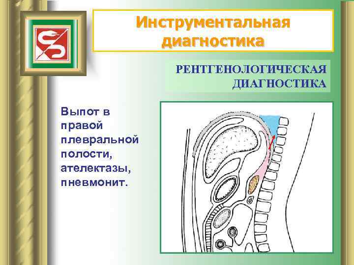 Инструментальная диагностика РЕНТГЕНОЛОГИЧЕСКАЯ ДИАГНОСТИКА Выпот в правой плевральной полости, ателектазы, пневмонит. 