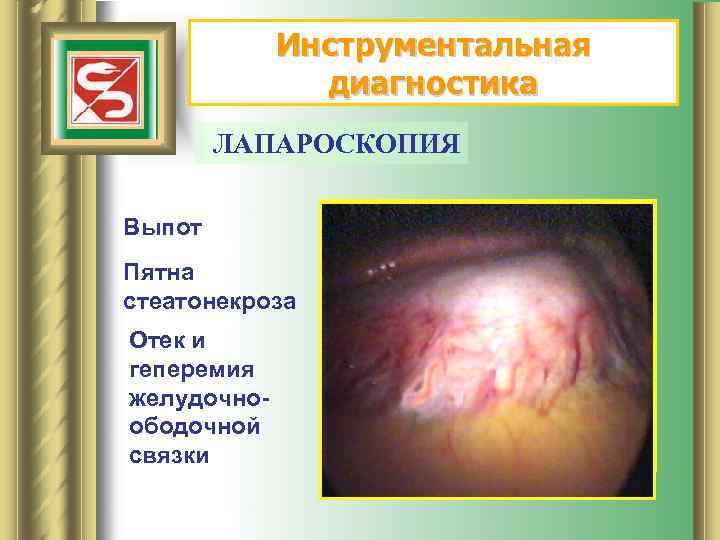 Инструментальная диагностика ЛАПАРОСКОПИЯ Выпот Пятна стеатонекроза Отек и геперемия желудочноободочной связки 