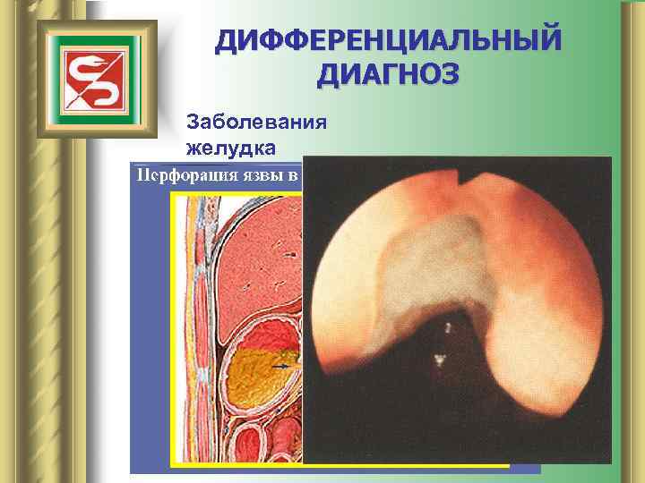 ДИФФЕРЕНЦИАЛЬНЫЙ ДИАГНОЗ Заболевания желудка 