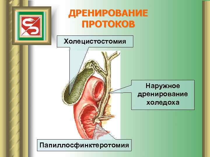 ДРЕНИРОВАНИЕ ПРОТОКОВ Холецистостомия Наружное дренирование холедоха Папиллосфинктеротомия 