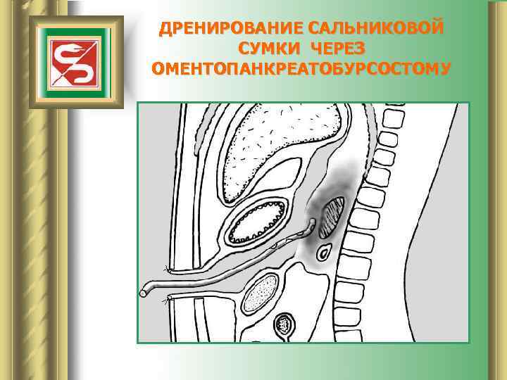 ДРЕНИРОВАНИЕ САЛЬНИКОВОЙ СУМКИ ЧЕРЕЗ ОМЕНТОПАНКРЕАТОБУРСОСТОМУ 