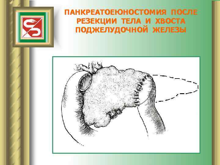 ПАНКРЕАТОЕЮНОСТОМИЯ ПОСЛЕ РЕЗЕКЦИИ ТЕЛА И ХВОСТА ПОДЖЕЛУДОЧНОЙ ЖЕЛЕЗЫ 
