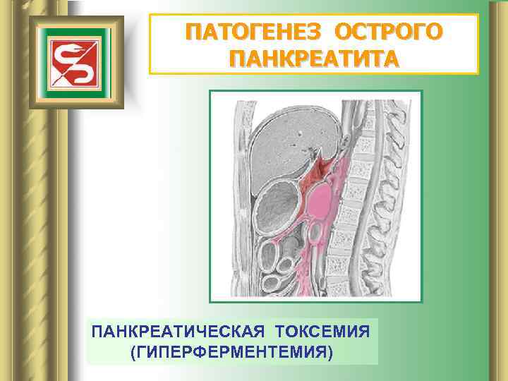 ПАТОГЕНЕЗ ОСТРОГО ПАНКРЕАТИТА ПАНКРЕАТИЧЕСКАЯ ТОКСЕМИЯ (ГИПЕРФЕРМЕНТЕМИЯ) 