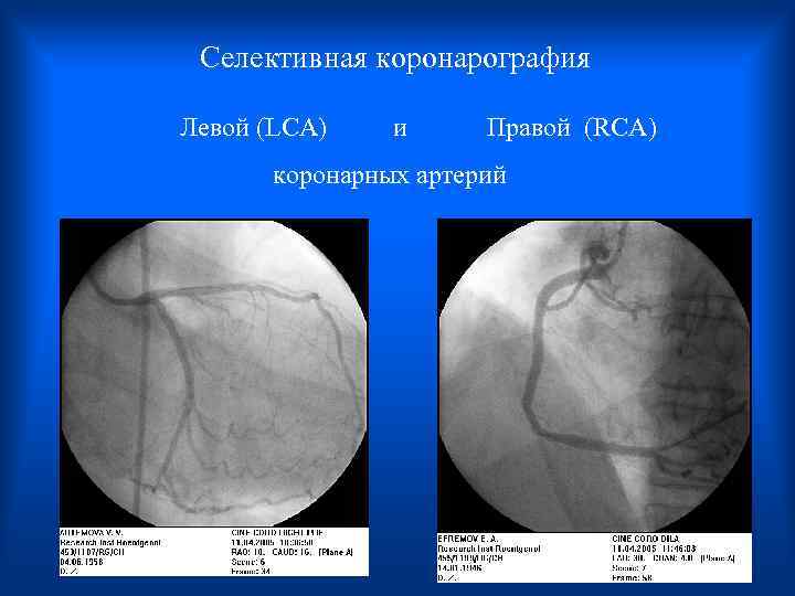  Селективная коронарография Левой (LCA) и Правой (RCA) коронарных артерий 