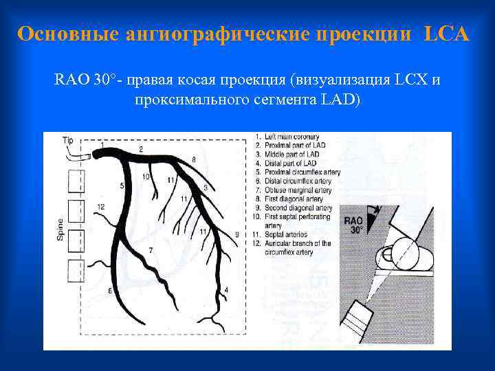 Основные ангиографические проекции LCA RAO 30°- правая косая проекция (визуализация LCX и проксимального сегмента