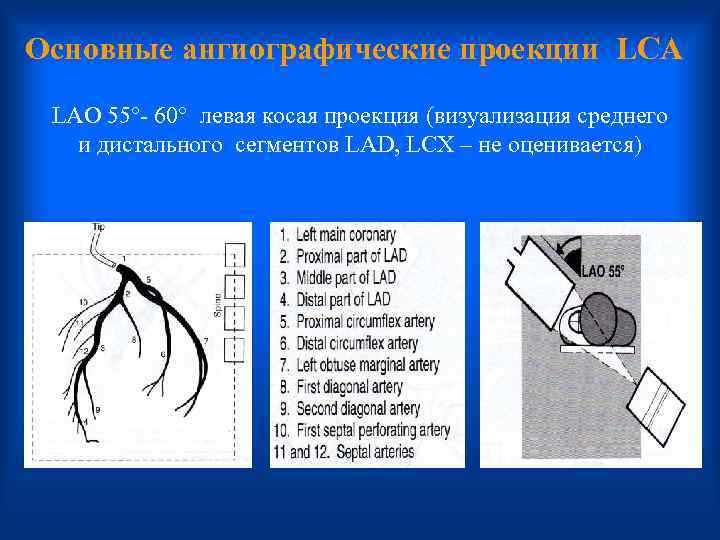 Основные ангиографические проекции LCA LAO 55°- 60° левая косая проекция (визуализация среднего и дистального