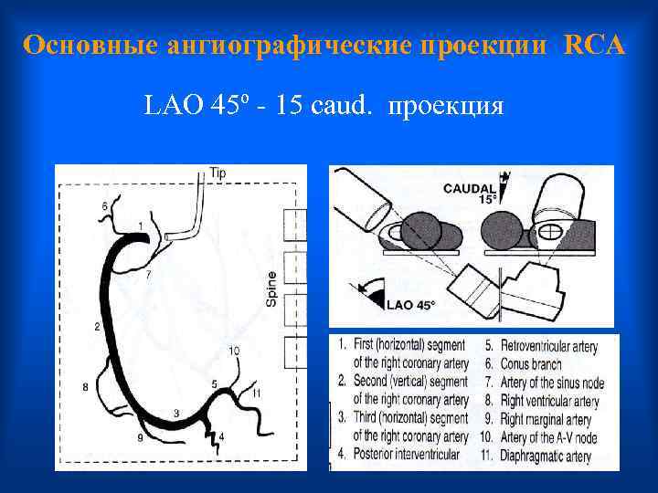 Основные ангиографические проекции RCA LAO 45º - 15 caud. проекция 