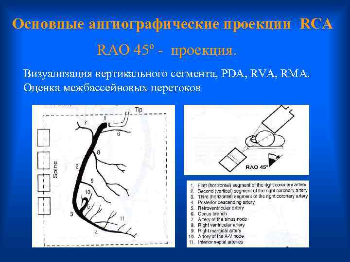 Основные ангиографические проекции RCA RAO 45º - проекция. Визуализация вертикального сегмента, PDA, RVA, RMA.