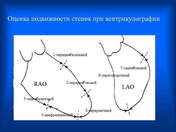 Оценка подвижности стенок при вентрикулографии 1 -переднебазальный 7 -заднебоковой 6 -перегородочный RAO 2 -переднебоковой