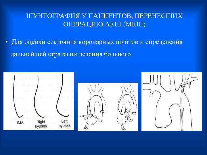  ШУНТОГРАФИЯ У ПАЦИЕНТОВ, ПЕРЕНЕСШИХ ОПЕРАЦИЮ АКШ (МКШ) • Для оценки состояния коронарных шунтов