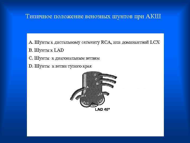 Типичное положение венозных шунтов при АКШ A. Шунты к дистальному сегменту RCA, или доминантной