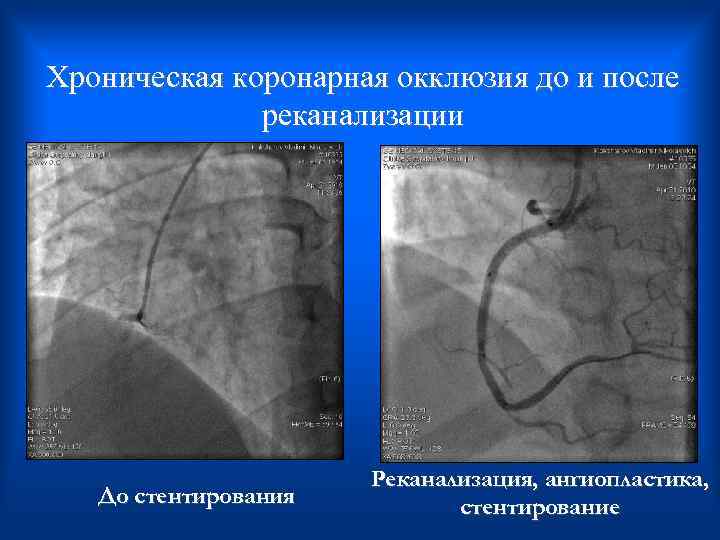 Хроническая коронарная окклюзия до и после реканализации Реканализация, ангиопластика, До стентирования стентирование 