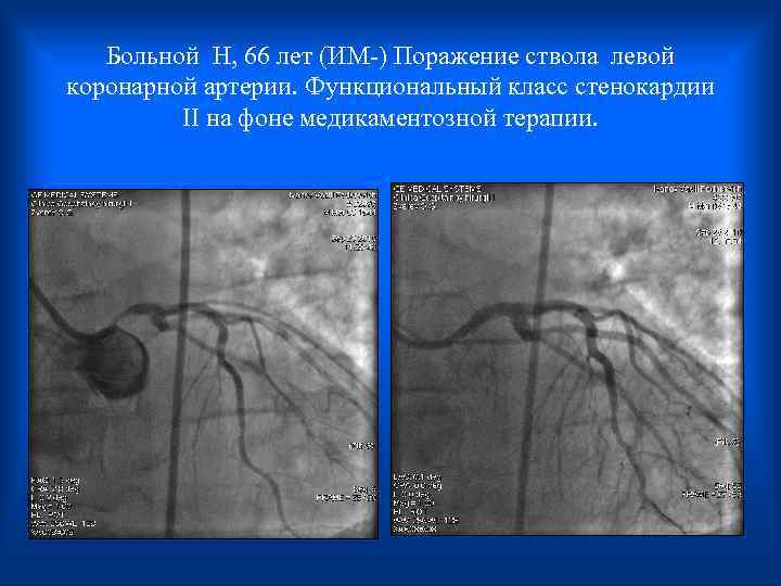  Больной H, 66 лет (ИМ-) Поражение ствола левой коронарной артерии. Функциональный класс стенокардии