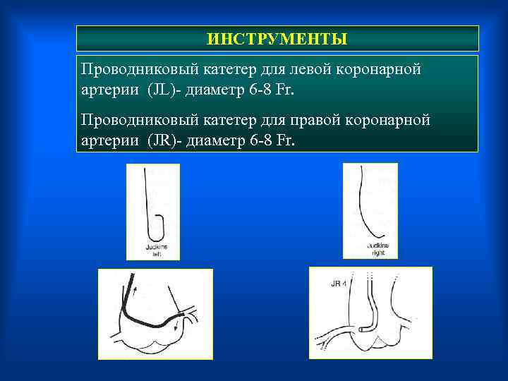  ИНСТРУМЕНТЫ Проводниковый катетер для левой коронарной артерии (JL)- диаметр 6 -8 Fr. Проводниковый