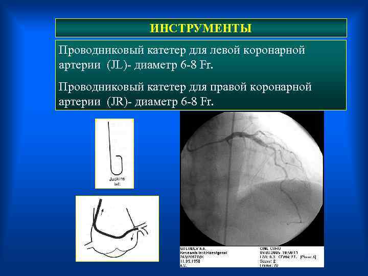  ИНСТРУМЕНТЫ Проводниковый катетер для левой коронарной артерии (JL)- диаметр 6 -8 Fr. Проводниковый