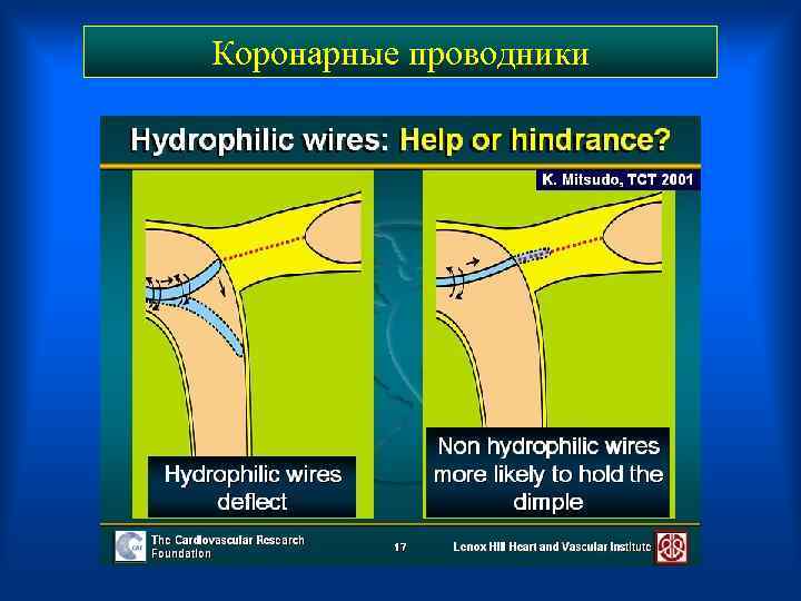 Коронарные проводники 