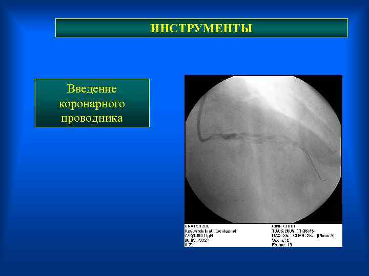  ИНСТРУМЕНТЫ Введение коронарного проводника 