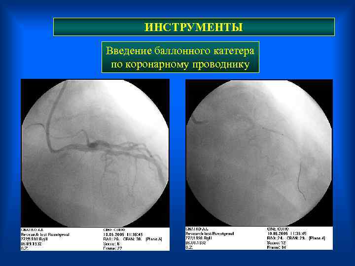  ИНСТРУМЕНТЫ Введение баллонного катетера по коронарному проводнику 