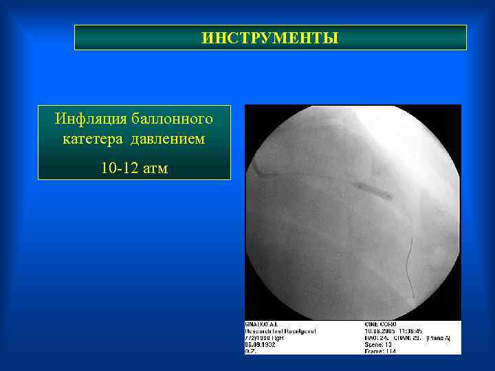  ИНСТРУМЕНТЫ Инфляция баллонного катетера давлением 10 -12 атм 