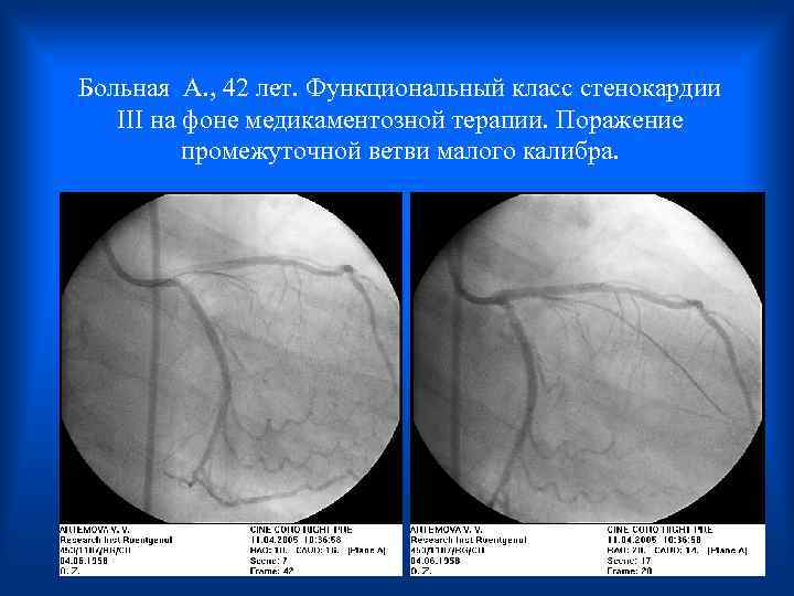 Больная А. , 42 лет. Функциональный класс стенокардии III на фоне медикаментозной терапии. Поражение
