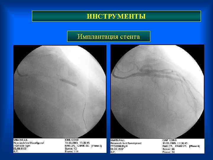  ИНСТРУМЕНТЫ Имплантация стента 