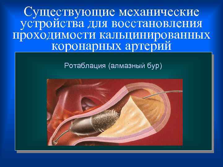  Существующие механические устройства для восстановления проходимости кальцинированных коронарных артерий Ротаблация (алмазный бур) 