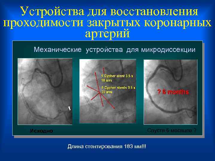  Устройства для восстановления проходимости закрытых коронарных артерий Механические устройства для микродиссекции Исходно Спустя