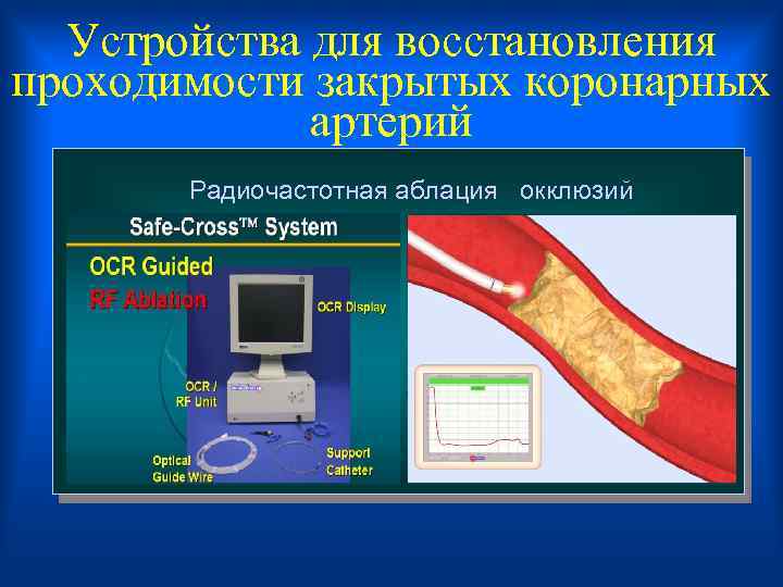  Устройства для восстановления проходимости закрытых коронарных артерий Радиочастотная аблация окклюзий 