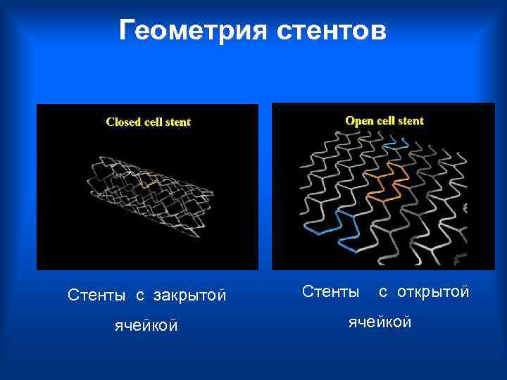  Геометрия стентов Стенты с закрытой Стенты с открытой ячейкой 