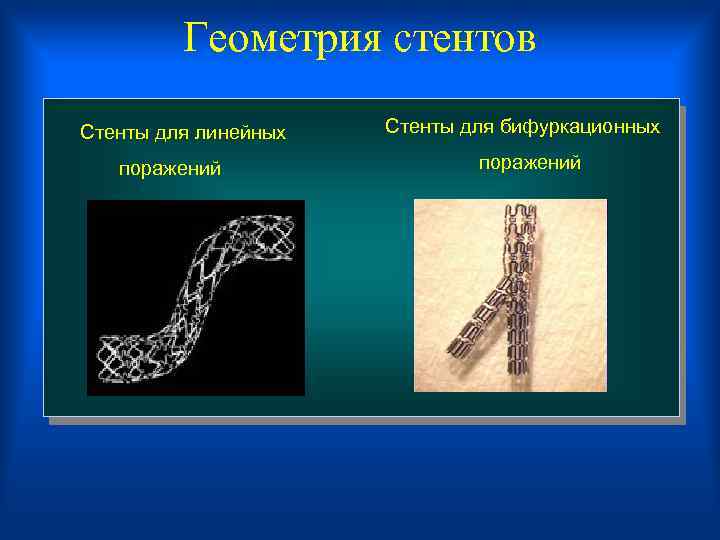  Геометрия стентов Стенты для линейных Стенты для бифуркационных поражений 