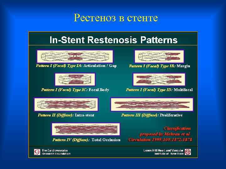  Рестеноз в стенте 