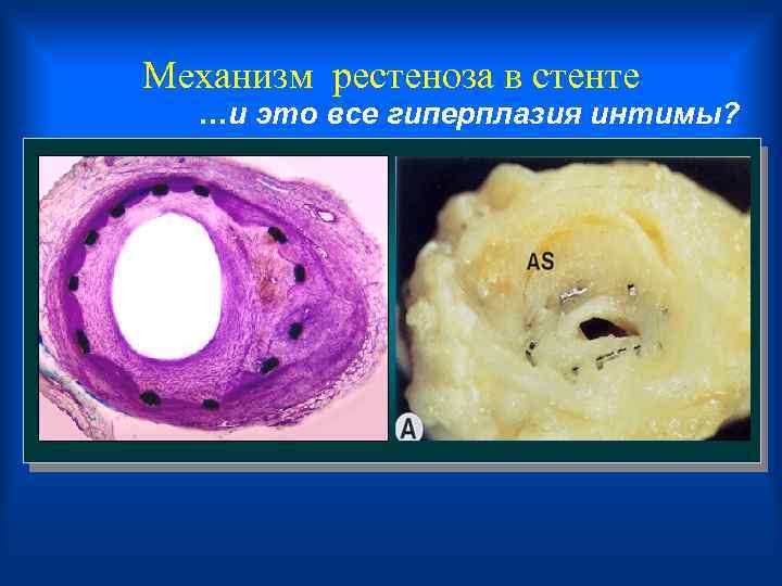 Meханизм рестеноза в стенте …и это все гиперплазия интимы? 