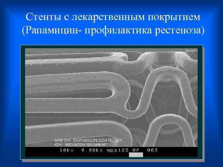  Стенты с лекарственным покрытием (Рапамицин- профилактика рестеноза) 