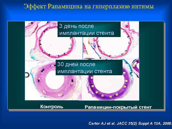 Эффект Рапамицина на гиперплазию интимы 3 день после имплантации стента 30 дней после имплантации