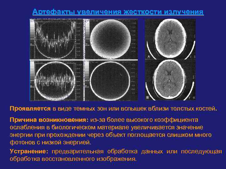 Артефакты увеличения жесткости излучения Проявляется в виде темных зон или вспышек вблизи толстых костей.