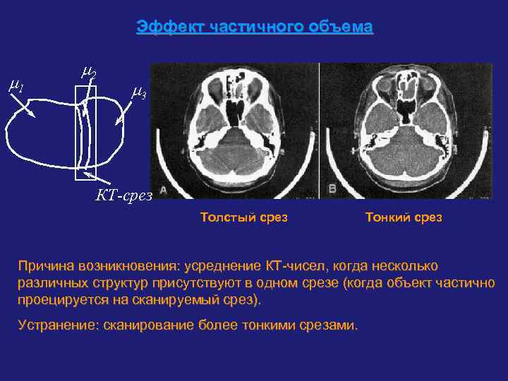 Эффект частичного объема 1 2 3 КТ-срез Толстый срез Тонкий срез Причина возникновения: усреднение