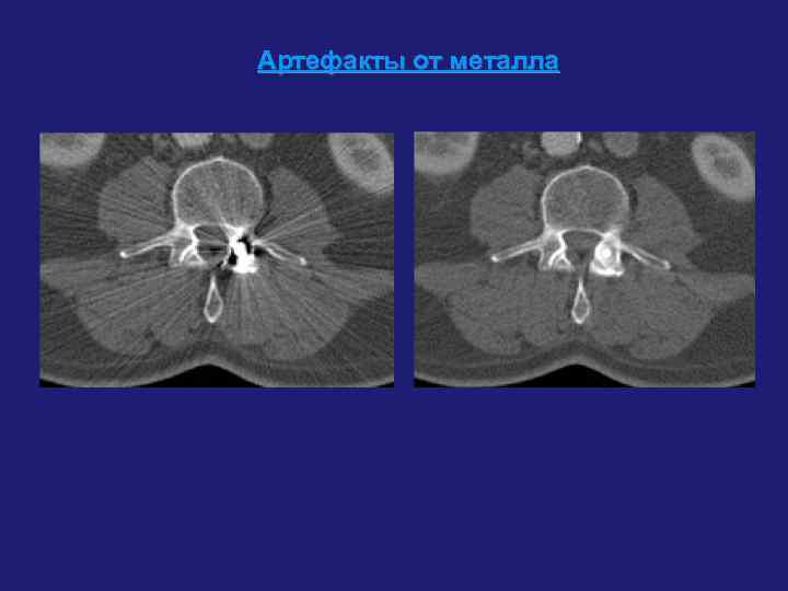 Артефакты от металла 