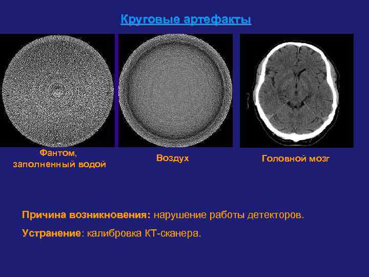 Круговые артефакты Фантом, заполненный водой Воздух Головной мозг Причина возникновения: нарушение работы детекторов. Устранение: