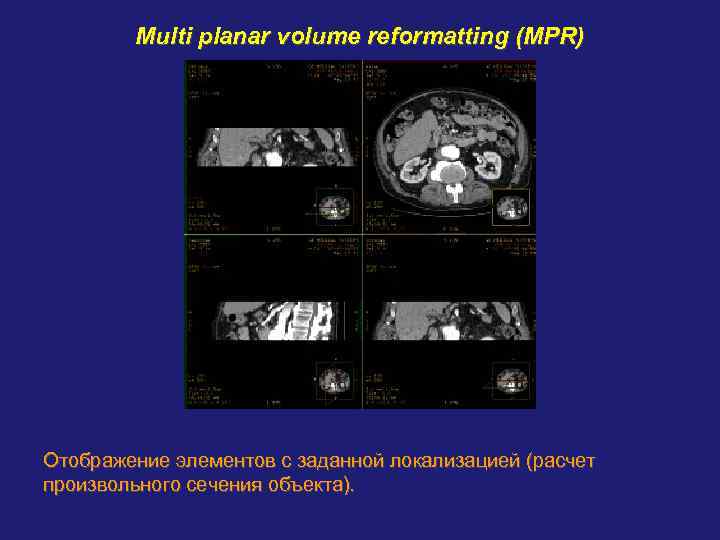 Multi planar volume reformatting (MPR) Отображение элементов с заданной локализацией (расчет произвольного сечения объекта).