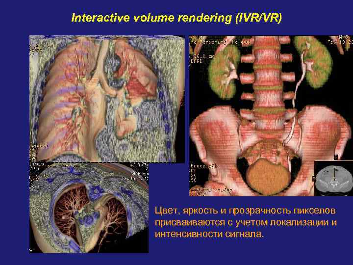 Interactive volume rendering (IVR/VR) Цвет, яркость и прозрачность пикселов присваиваются с учетом локализации и